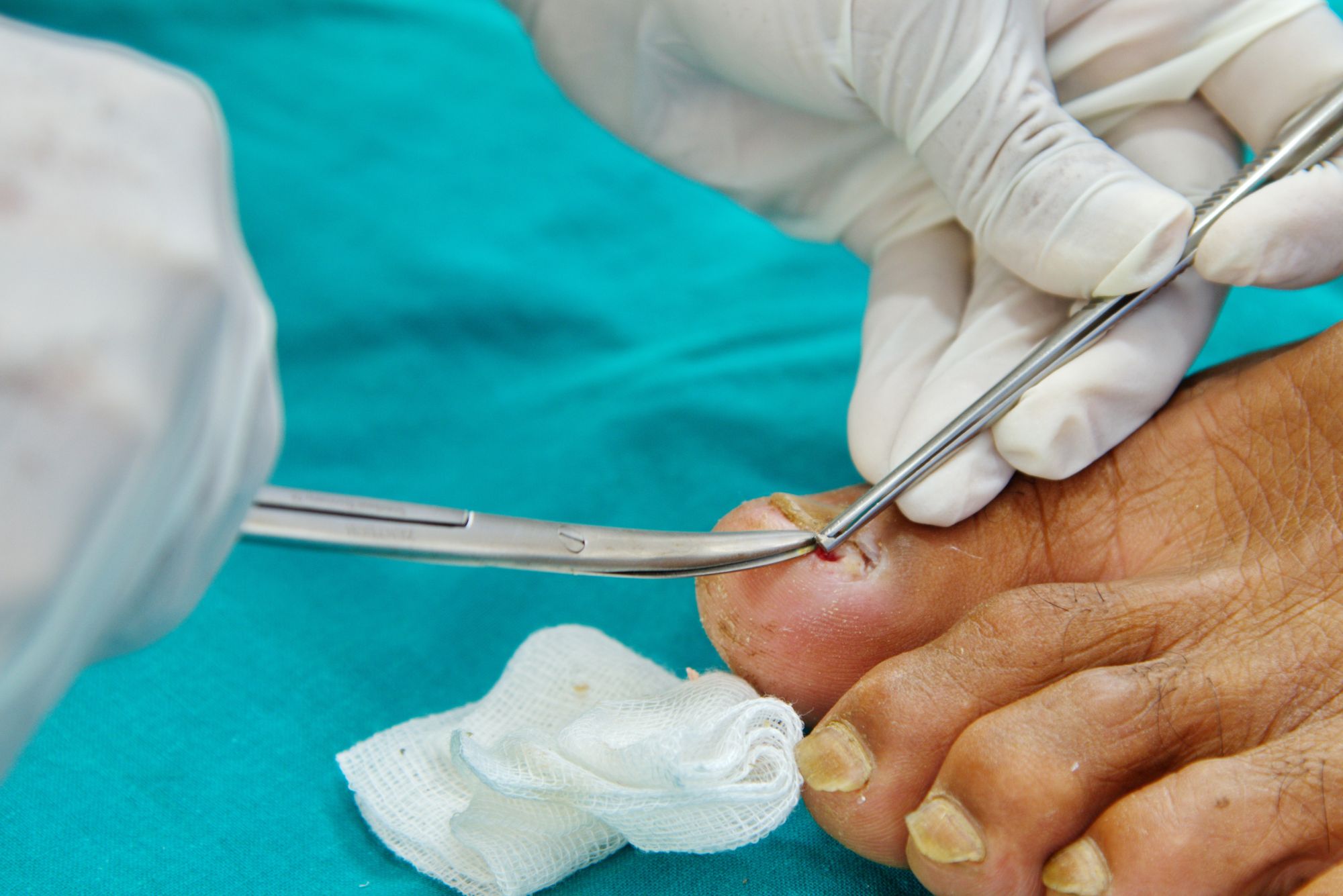 Ingrown Toenail Treatments | Foot Doctor San Antonio, TX