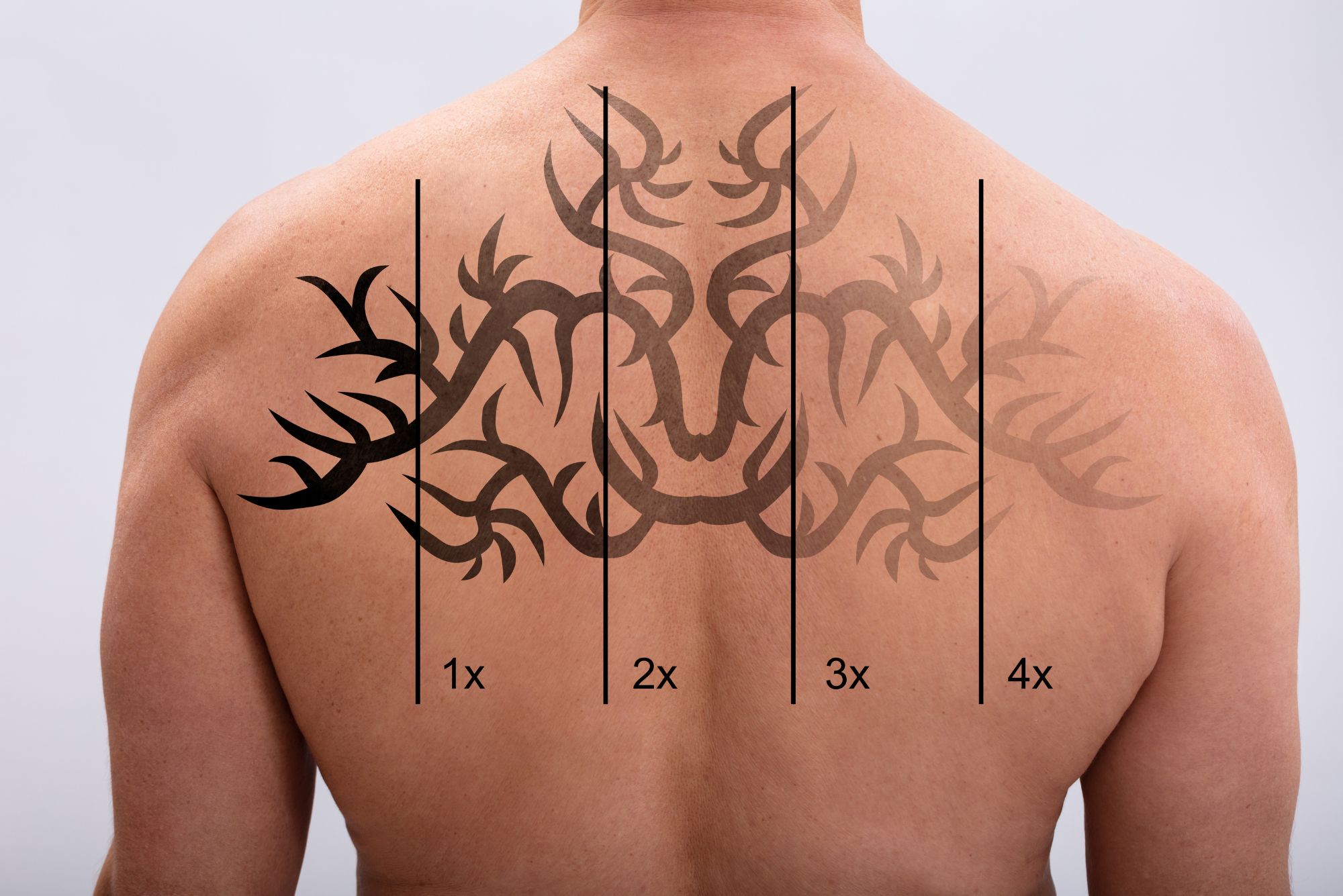 Tattoo Removal Methods – Advice Tattoo